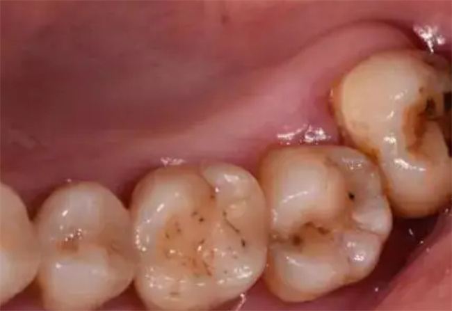 牙缝会不会因拔智齿变大拔智齿后牙缝会变大吗(拔了智齿牙缝会大吗)