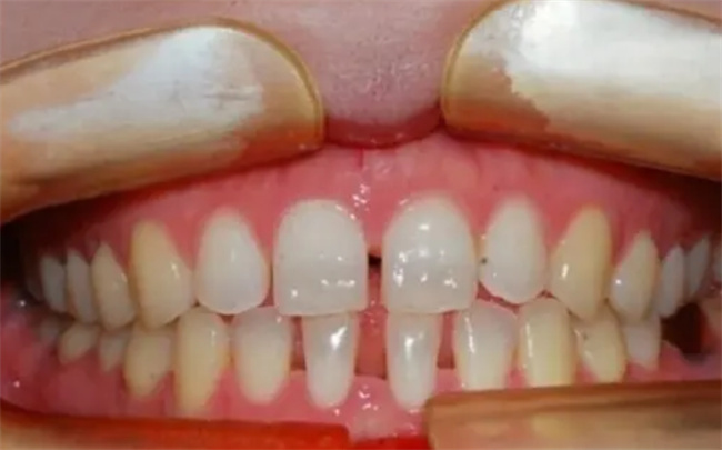 拔了智齿牙缝会大吗