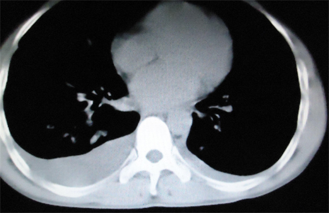 什么情况下需要查肺部ct