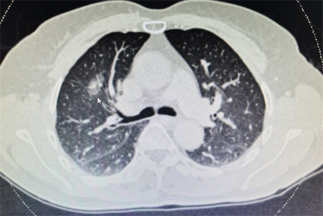 什么情况下需要查肺部ct