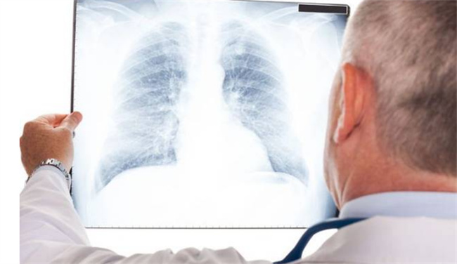 干咳后来有痰是肺炎吗