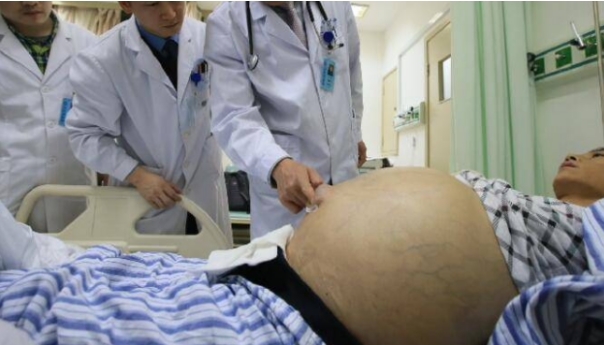 肝腹水怎么消除肝腹水有什么偏方(肝腹水的治疗 4种方法能治肝腹水)