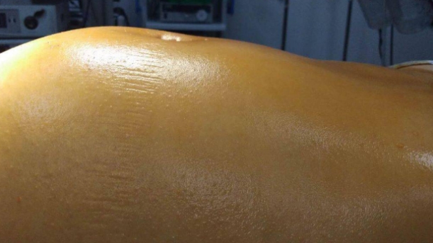 肝腹水的治疗 4种方法能治肝腹水