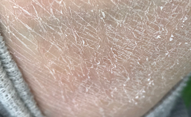 戈登发明的皮肤细胞什么术