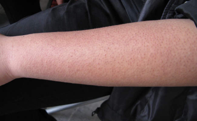 戈登发明的皮肤细胞什么术