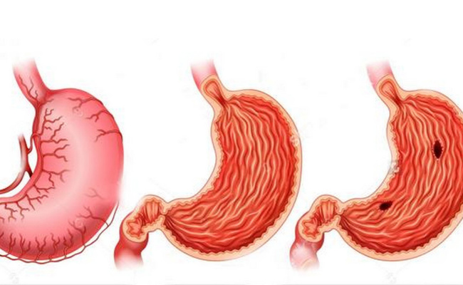 胃酸过多会引起什么症状