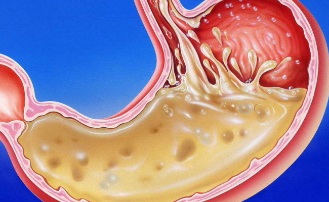 胃酸过多会引起什么症状
