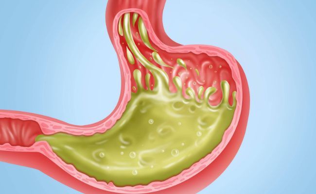 胃酸过多会引起什么症状