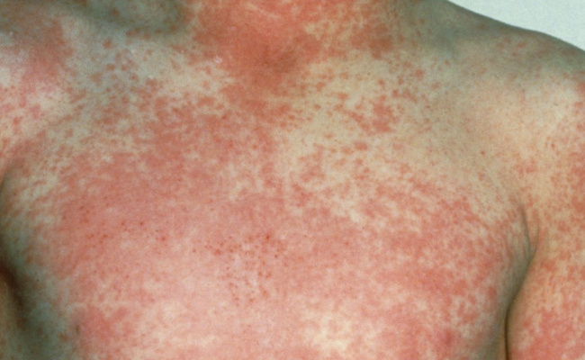 ​猩红热症状怎么引起的猩红热是什么(什么是猩红热有什么症状)