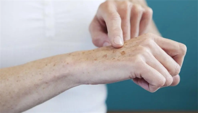 ​怎样防止老年斑的出现老年斑原因是什么(老年斑的形成原因与防治)