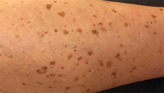 老年斑的形成原因与防治