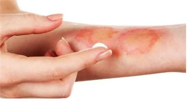 ​高温油烫伤后怎么办高温油烫伤后怎么处理(高温油烫伤后怎么办)