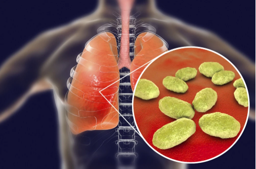 支原体肺炎是新冠吗