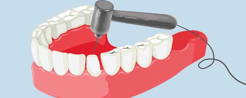 洗牙对牙有伤害吗洗牙影响牙齿健康吗(洗牙对牙齿有危害么)