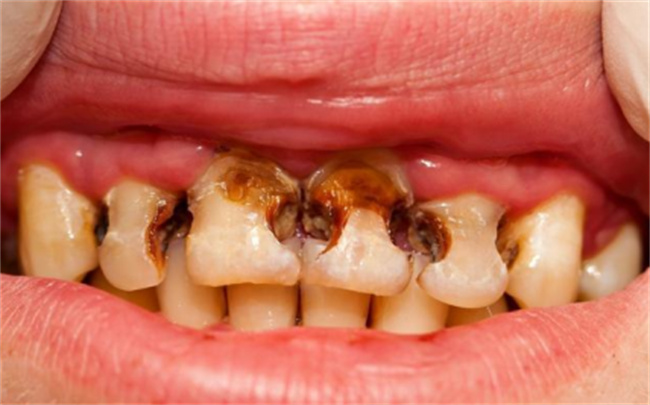 干燥综合征导致牙齿坏了怎么办