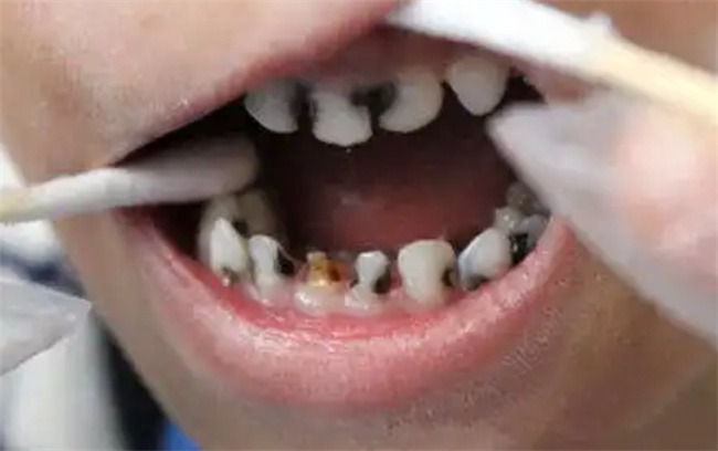 烂牙“元凶”是干燥综合征吗干燥综合征有哪些症状(干燥综合征导致牙齿坏了怎么办)