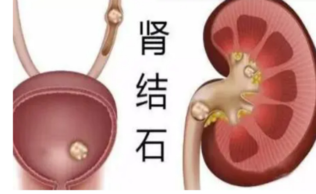 为什么肾脏容易长结石