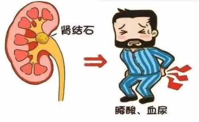 为什么肾脏容易长结石