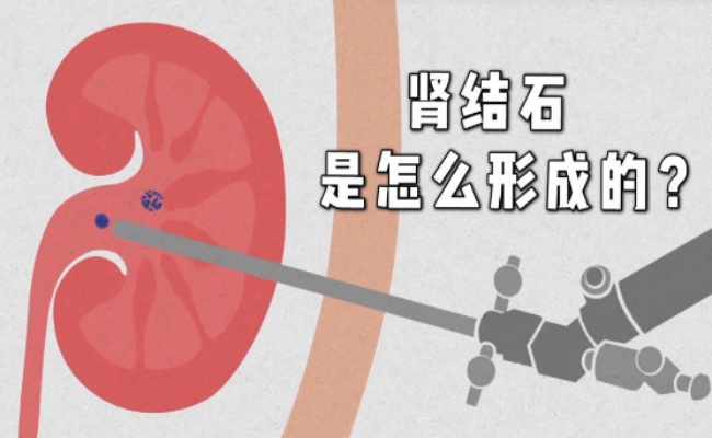 肾为什么会长结石如何避免肾结石(为什么肾脏容易长结石)