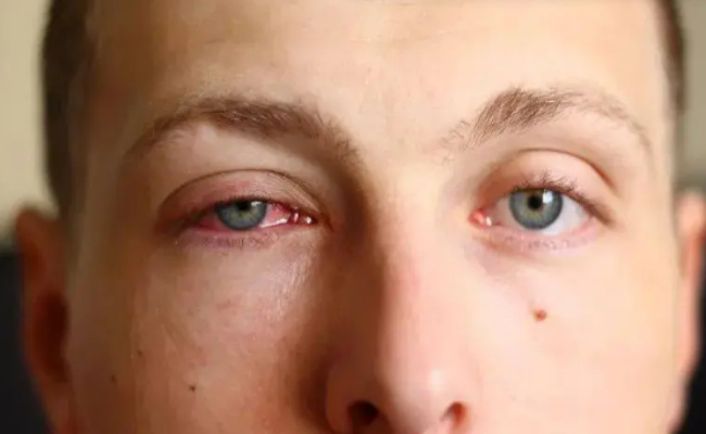 ​紫外线如何伤害眼睛紫外线对眼睛伤害大吗(紫外线灯对眼睛的危害)